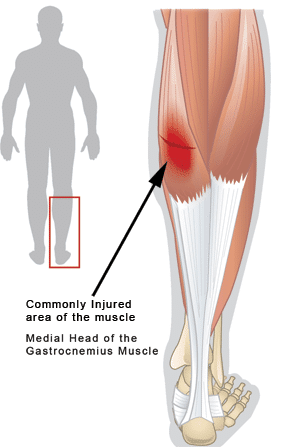 Healing a Strained Muscle: Protocols and Tips for a Speedy Recovery